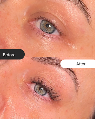 Before and after comparison of a woman's eye area with visible changes.