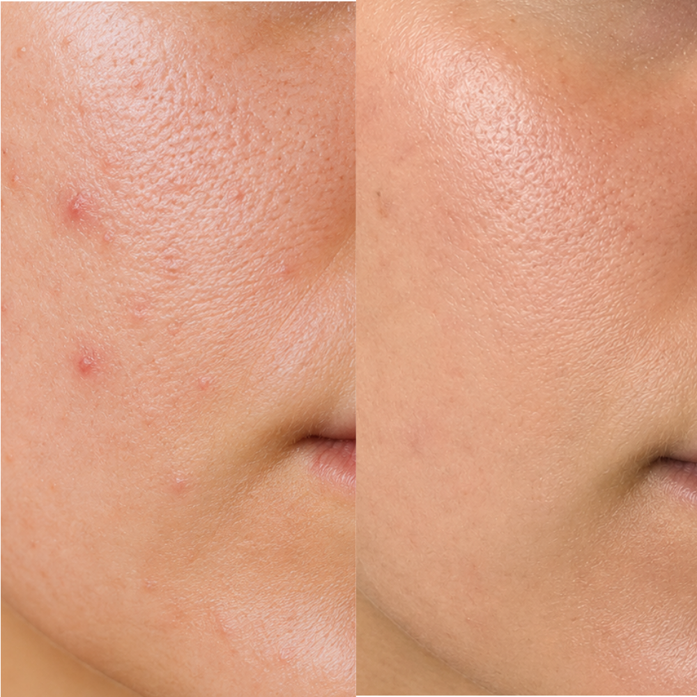 2% BHA Exfoliating Toner for Face - Pore Cleaner and Facial Exfoliator with Salicylic Acid