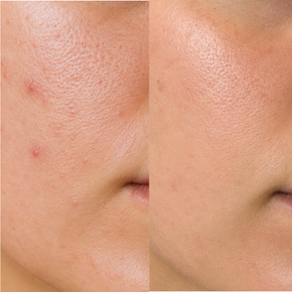 2% BHA Exfoliating Toner for Face - Pore Cleaner and Facial Exfoliator with Salicylic Acid